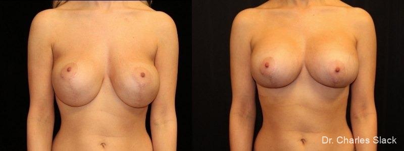 Breast Revision: Patient 8 - Before and After  