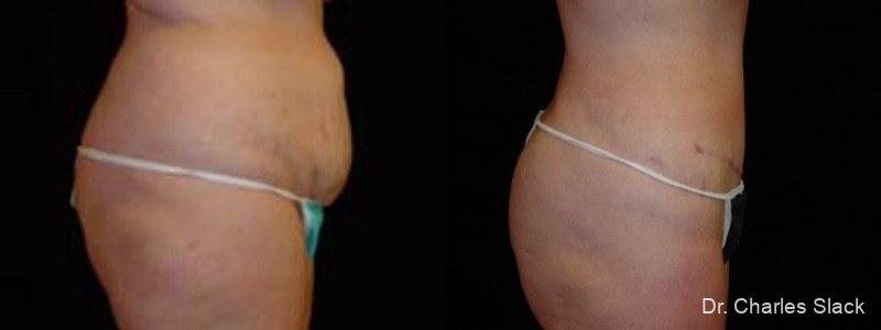 360 Body Contour: Patient 7 - Before and After  