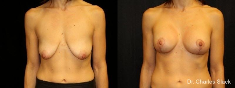 Breast Augmentation With Lift: Patient 6 - Before and After  