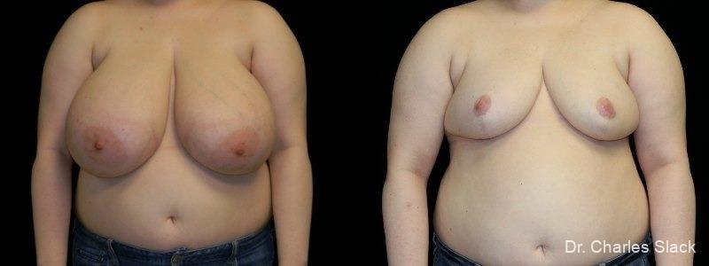 Breast Reduction: Patient 7 - Before and After  