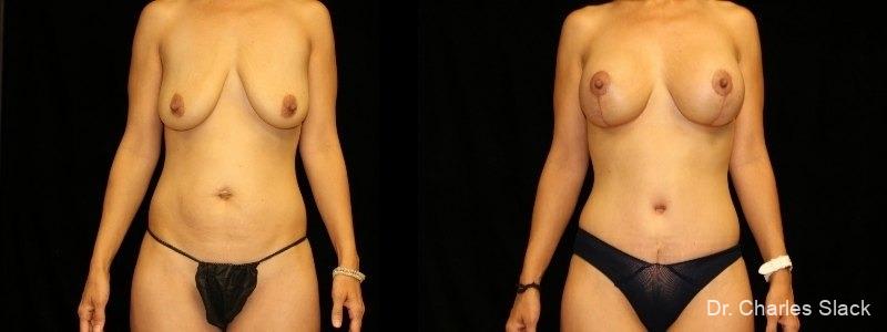 Breast Augmentation With Lift: Patient 9 - Before and After  