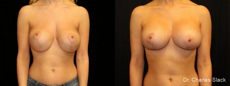 Breast Revision: Patient 4 - Before and After  