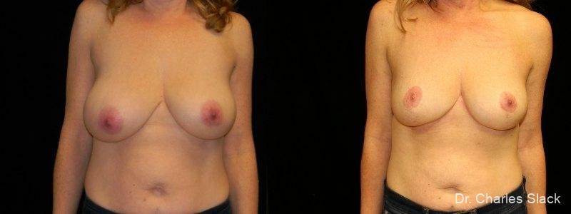 Breast Lift: Patient 6 - Before and After  