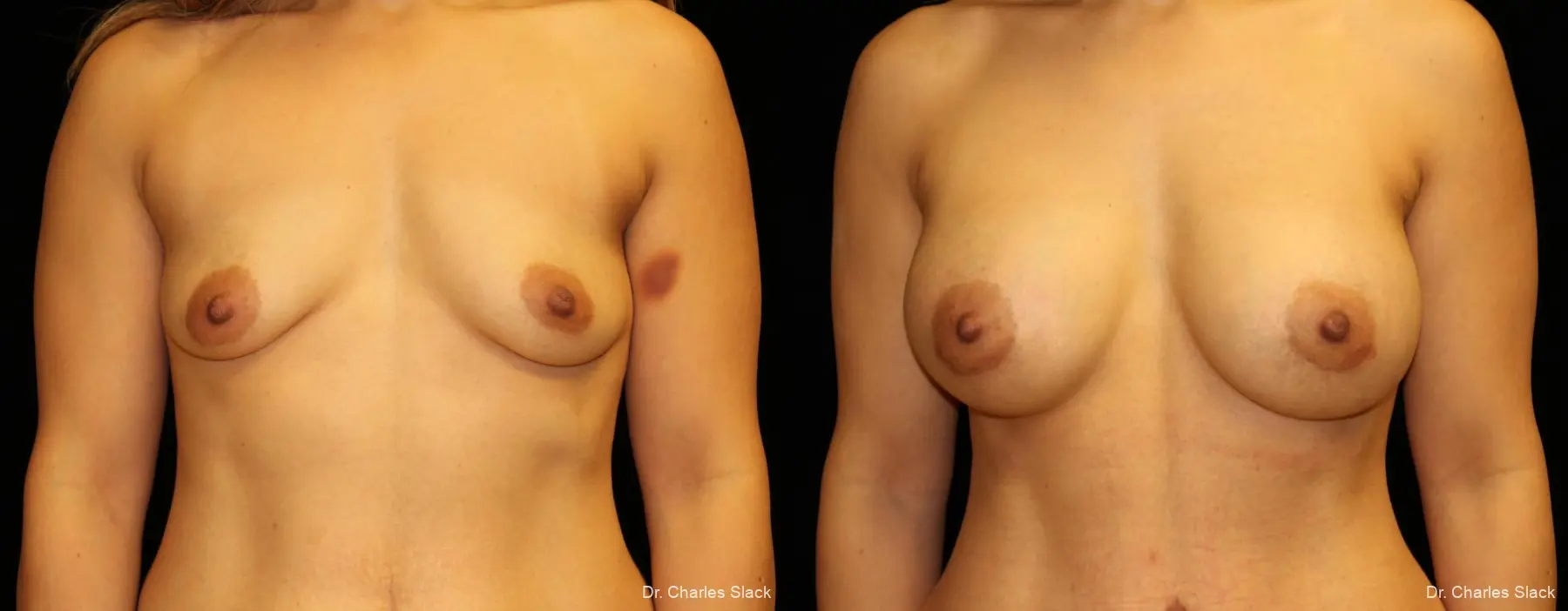 Breast Augmentation: Patient 5 - Before and After  