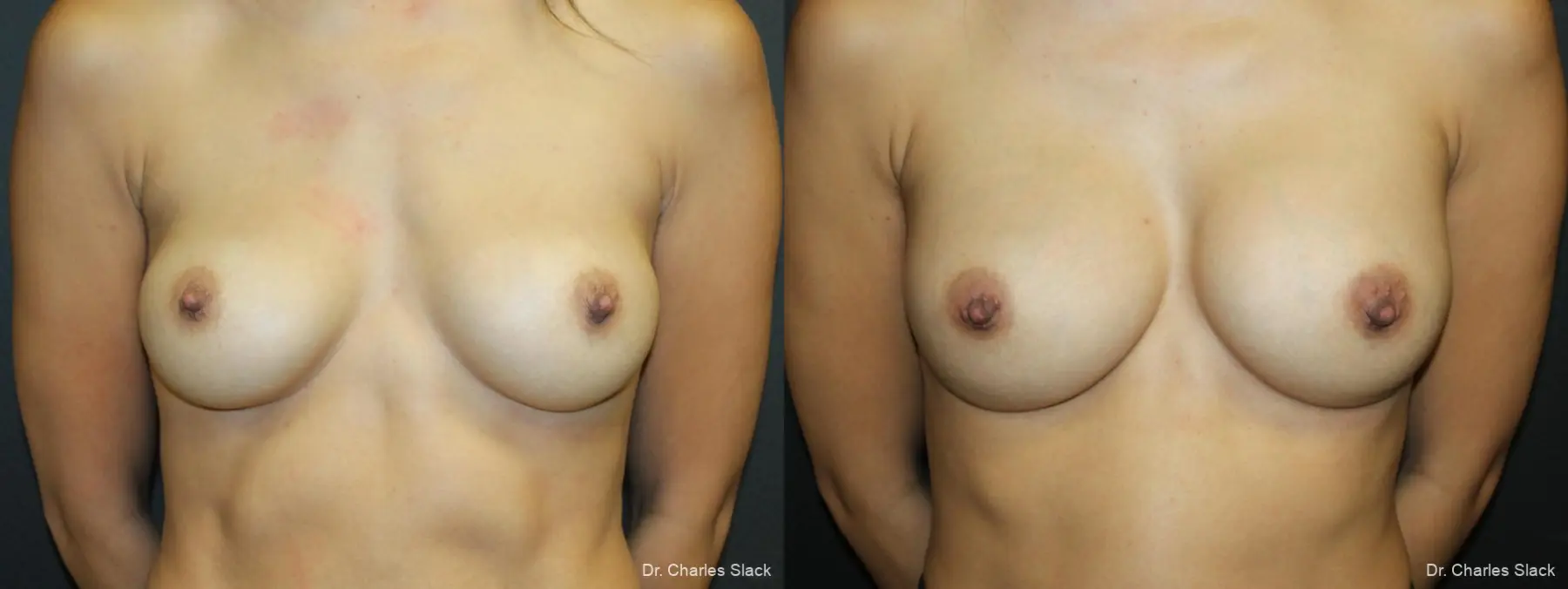 Breast Revision: Patient 9 - Before and After  