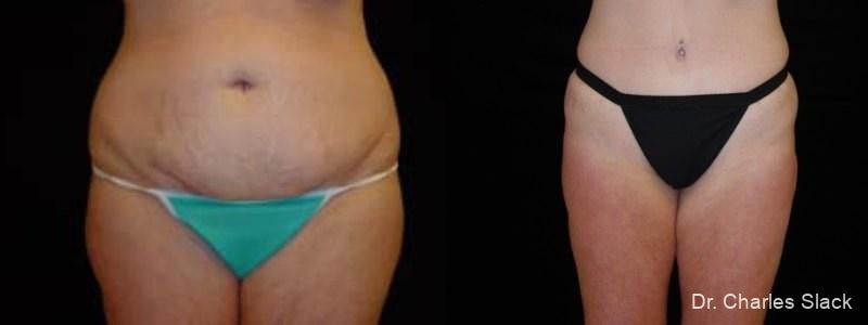 Tummy Tuck: Patient 10 - Before and After  