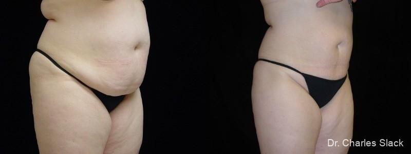 360 Body Contour: Patient 6 - Before and After  