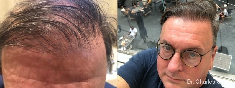 Hair Transplantation: Patient 3 - Before and After  