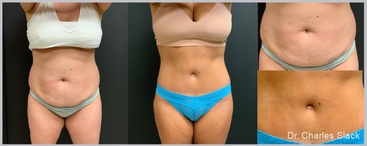 360 Body Contour: Patient 4 - Before and After  