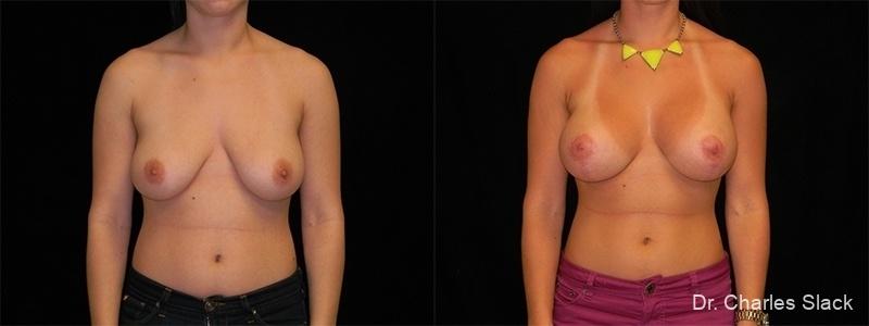 Breast Augmentation With Lift: Patient 1 - Before and After  