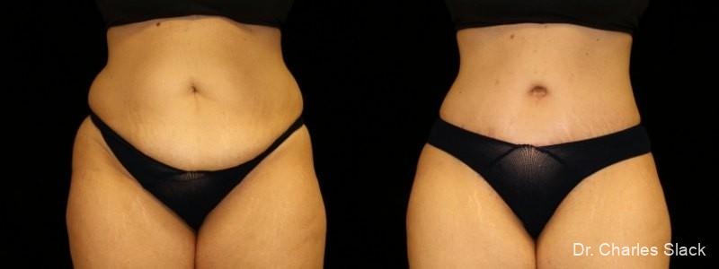360 Body Contour: Patient 5 - Before and After  