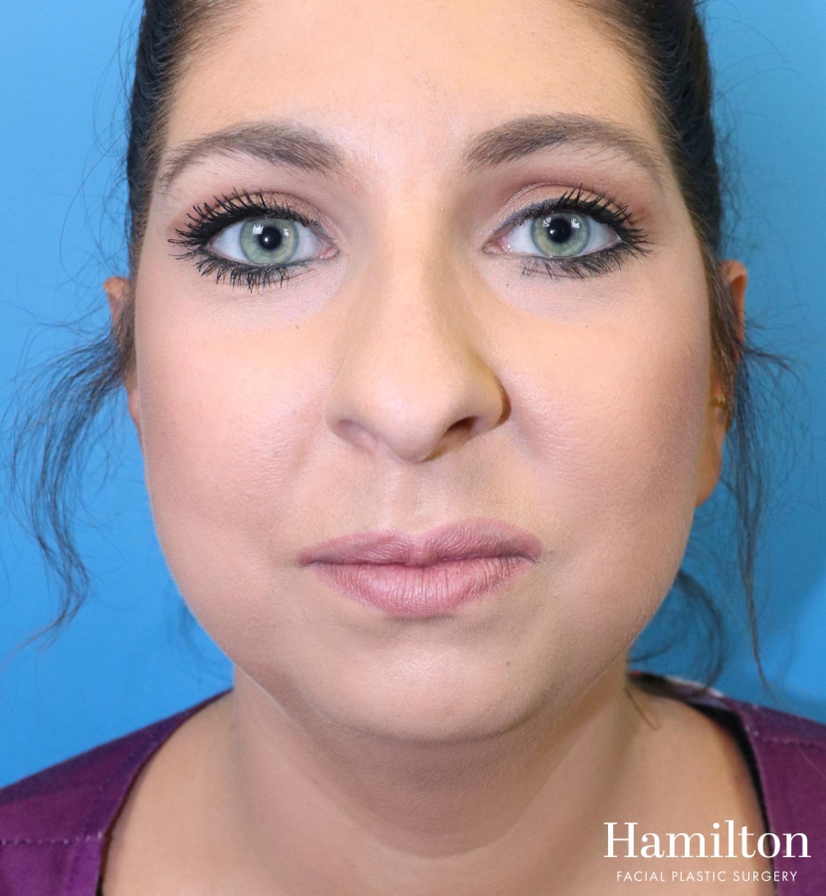 Chin Augmentation: Patient 9 - Before 4