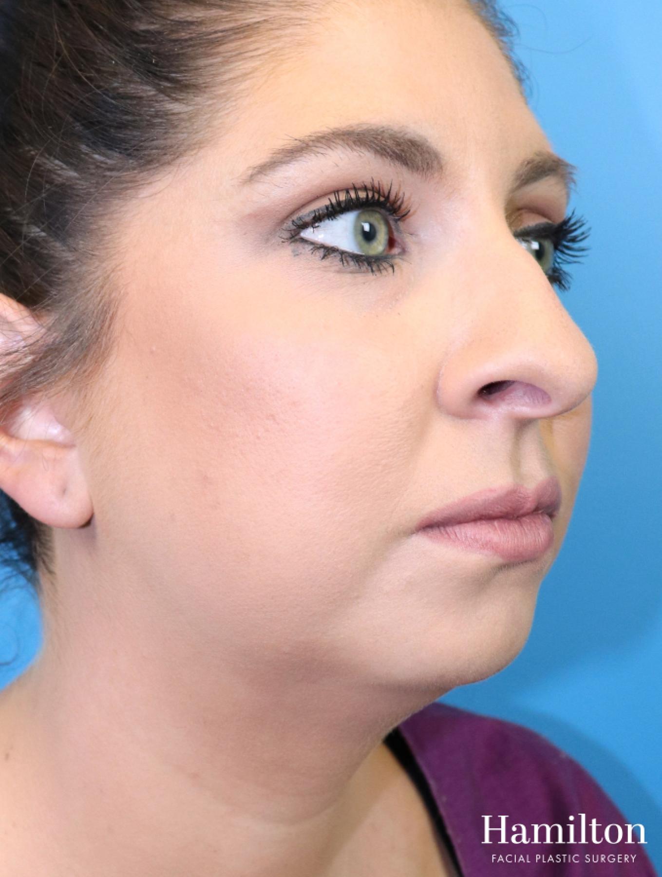 Chin Augmentation: Patient 9 - Before 3