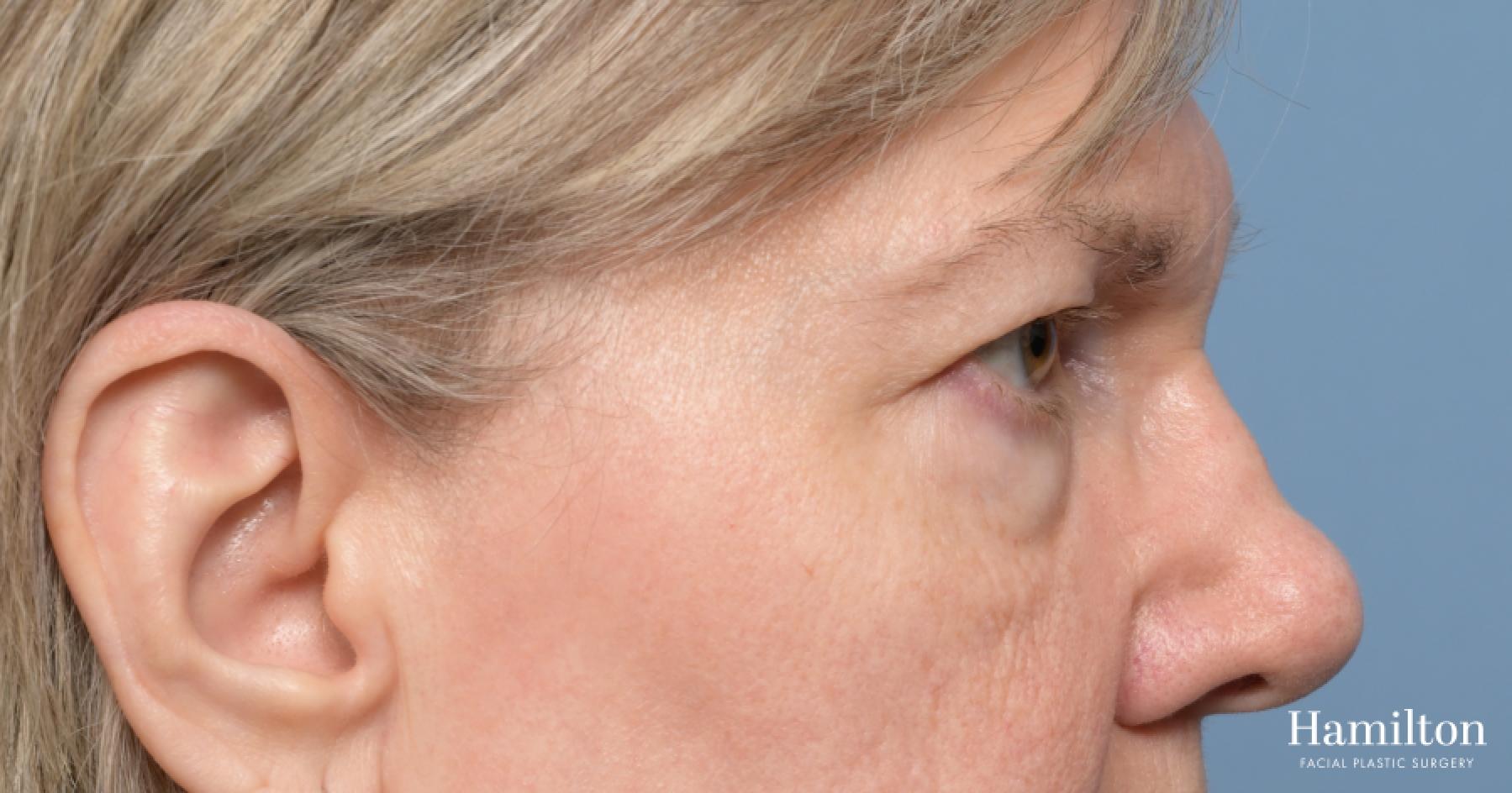 Blepharoplasty: Patient 18 - Before 3