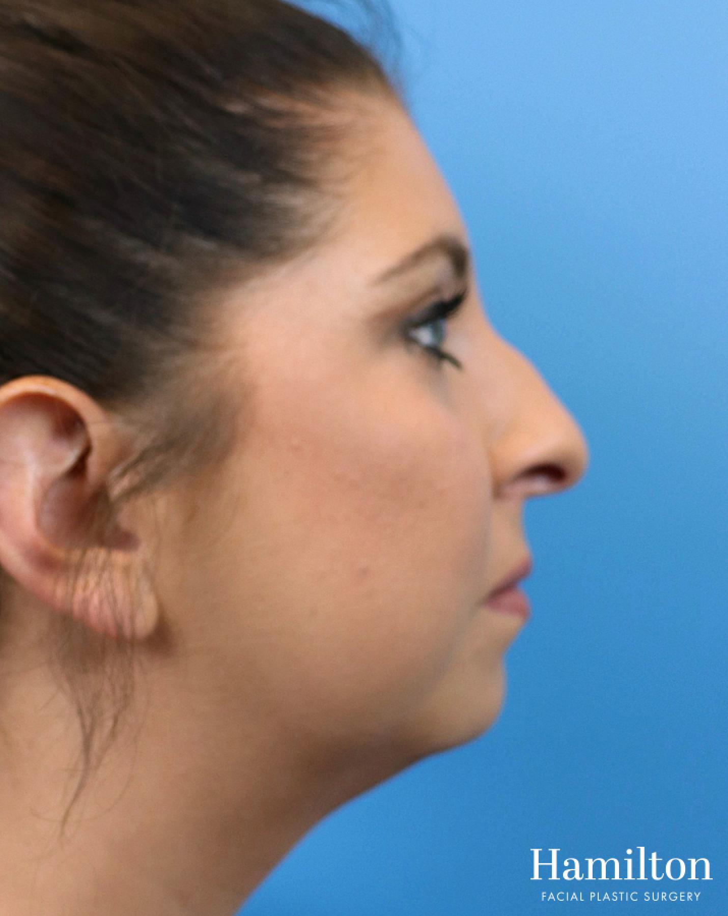 Chin Augmentation: Patient 9 - Before and After 5