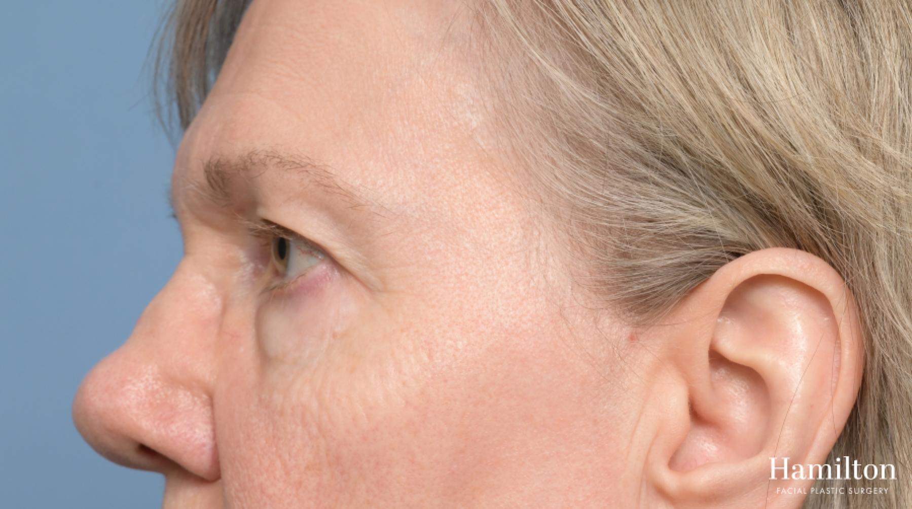 Blepharoplasty: Patient 18 - Before 2