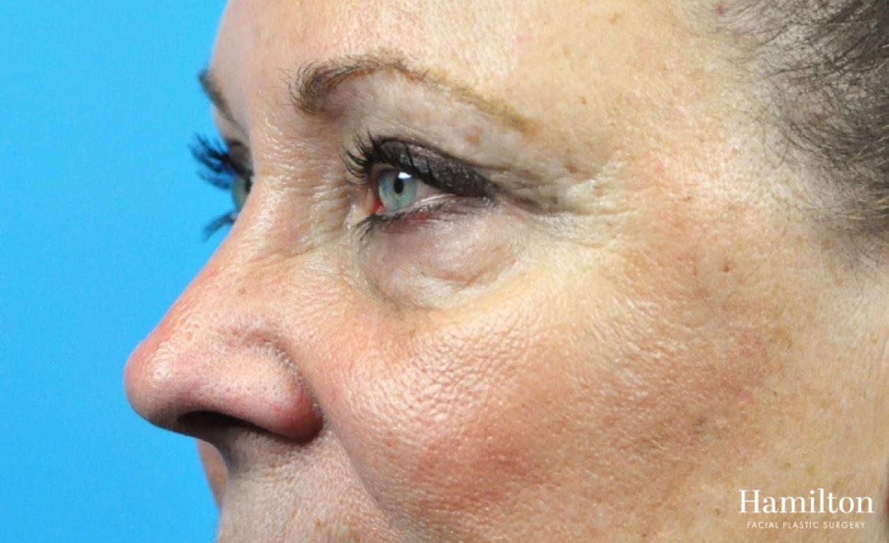 Blepharoplasty: Patient 27 - Before 1