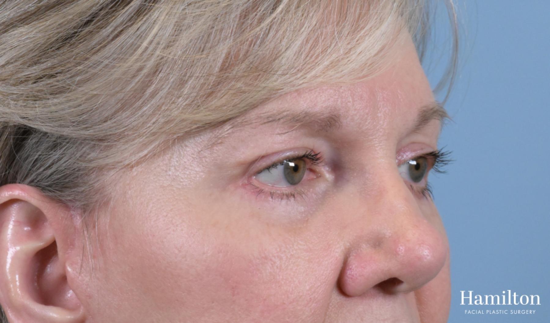 Blepharoplasty: Patient 18 - After 4