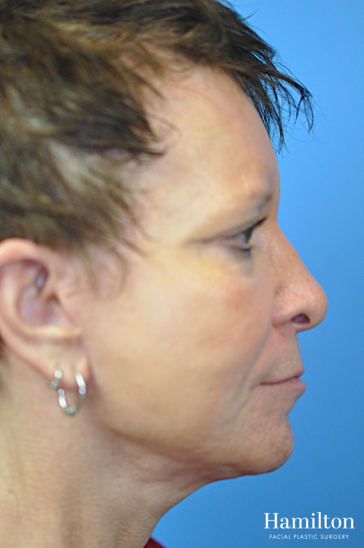 Facelift: Patient 39 - After 3