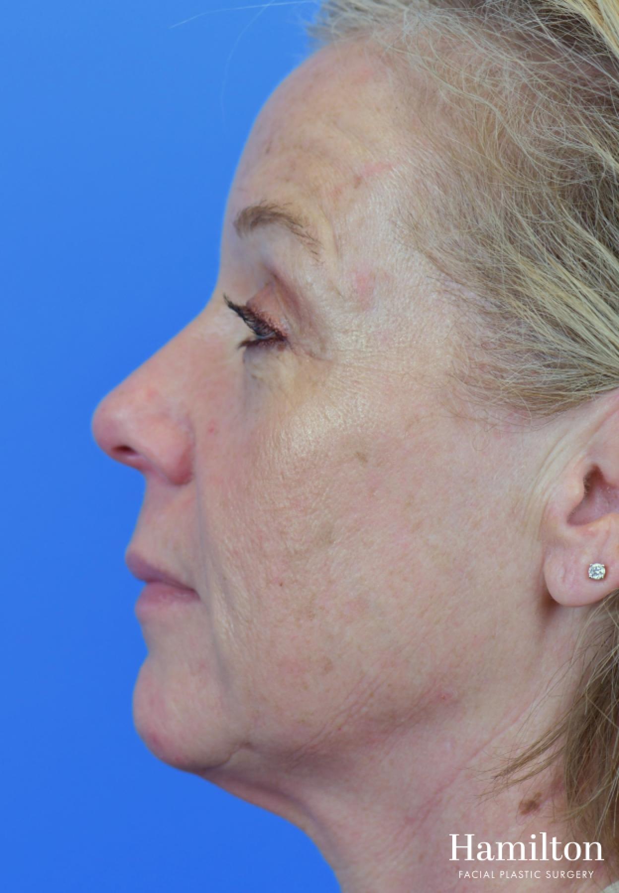 Facelift: Patient 30 - Before and After 5