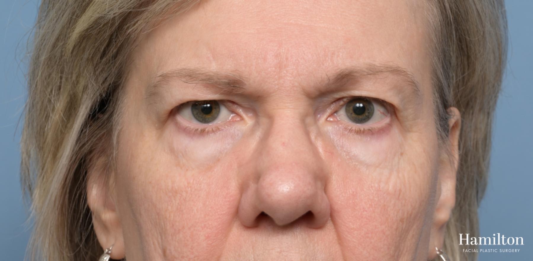 Blepharoplasty: Patient 18 - Before 1