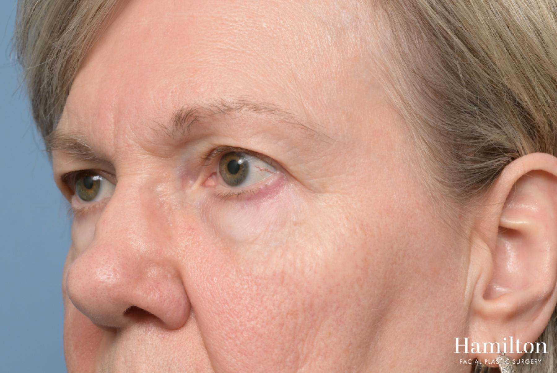 Blepharoplasty: Patient 18 - Before and After 5