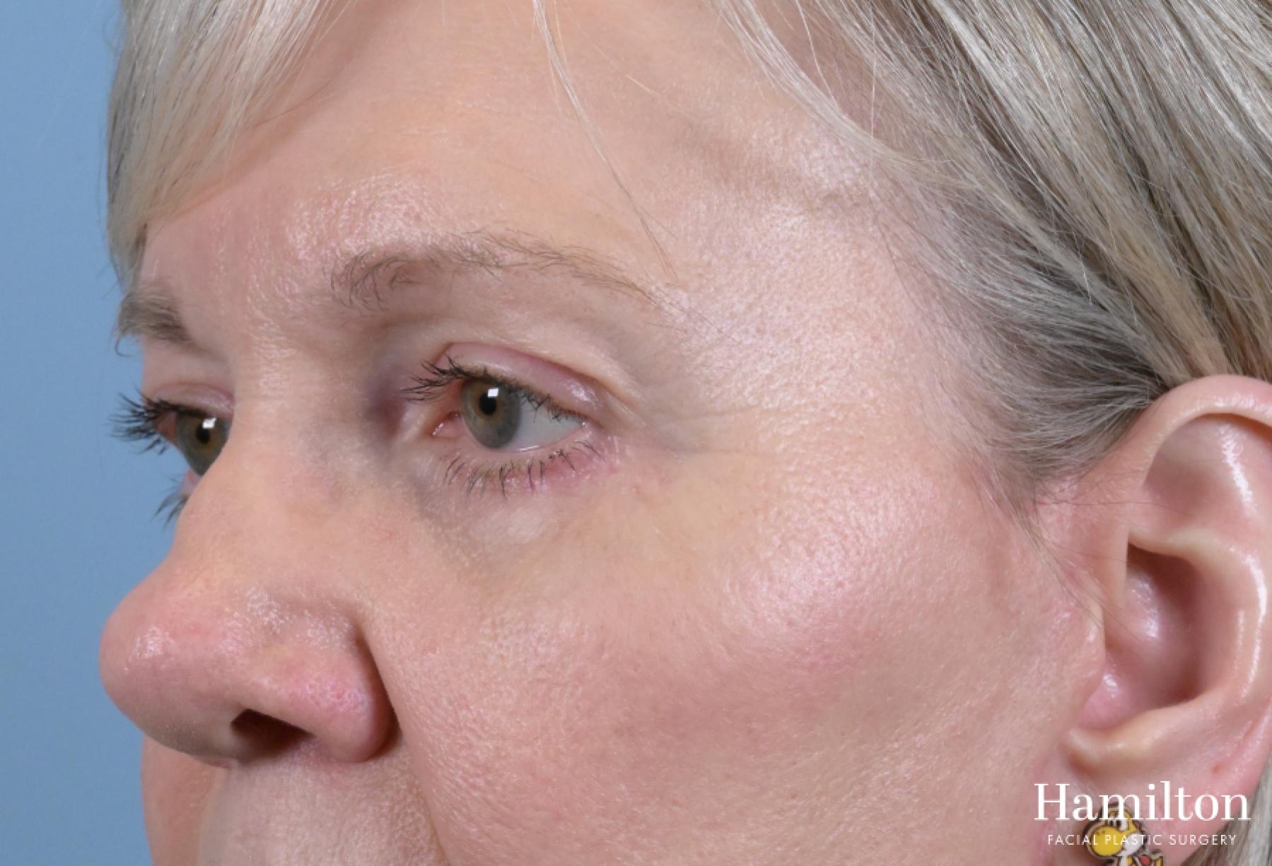 Blepharoplasty: Patient 18 - After 5