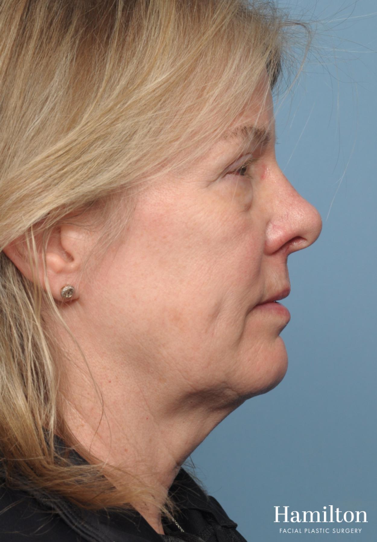 Facelift: Patient 40 - Before 2