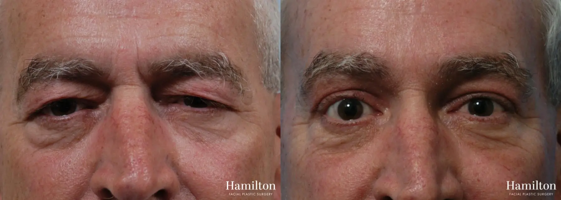 Blepharoplasty: Patient 24 - Before and After 1