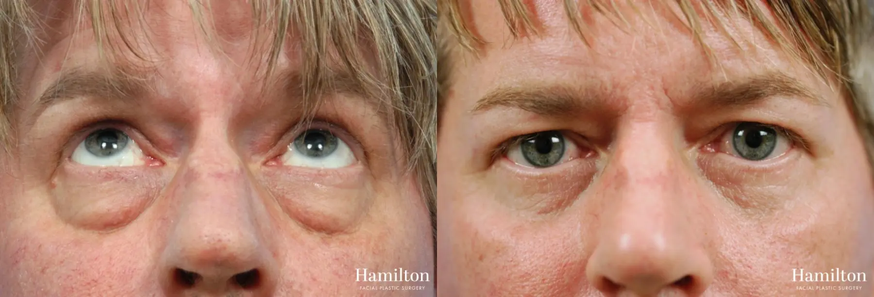 Blepharoplasty: Patient 23 - Before and After 1