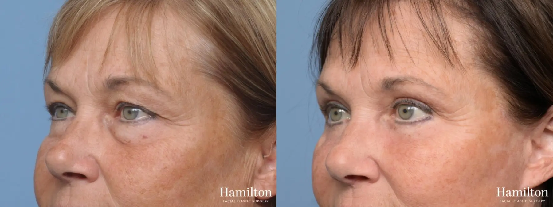 Blepharoplasty: Patient 2 - Before and After 2