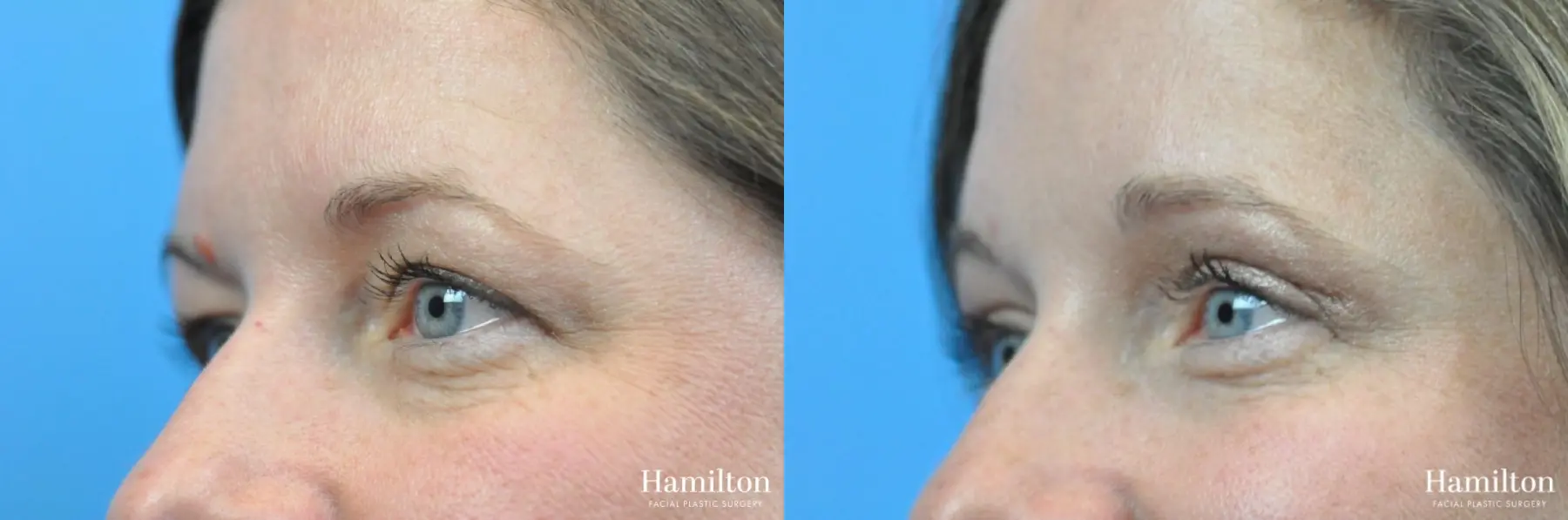 Blepharoplasty: Patient 17 - Before and After 4