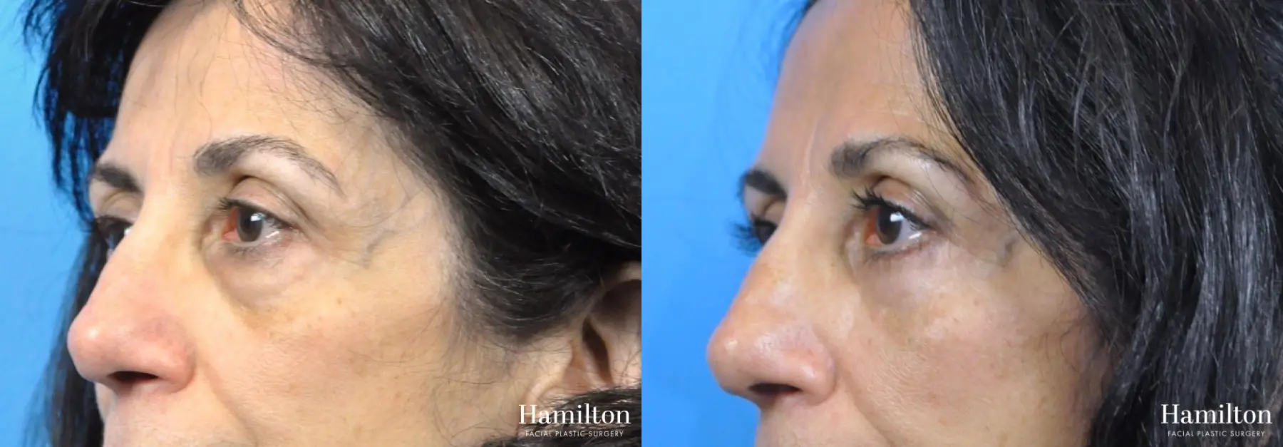 Blepharoplasty: Patient 10 - Before and After 2