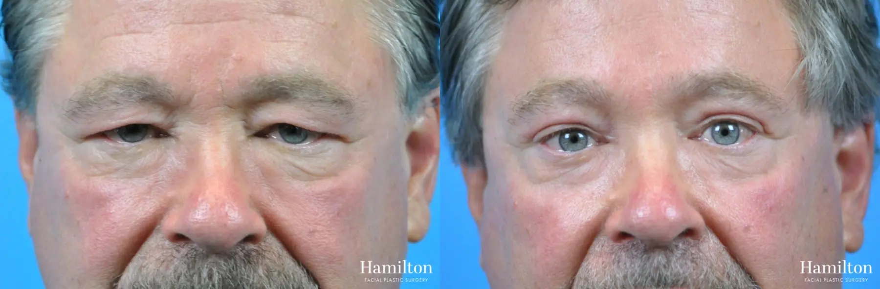 Blepharoplasty: Patient 19 - Before and After 3