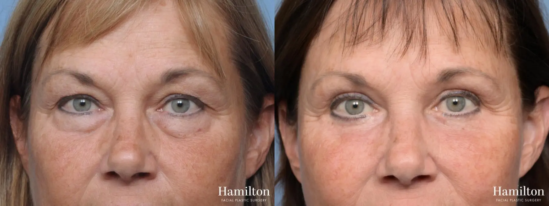 Blepharoplasty: Patient 2 - Before and After  