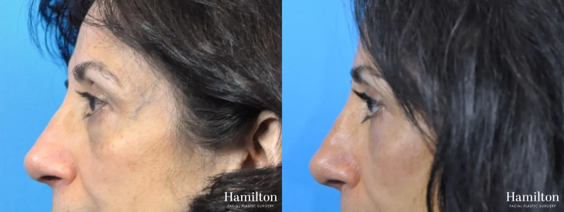 Blepharoplasty: Patient 10 - Before and After 4