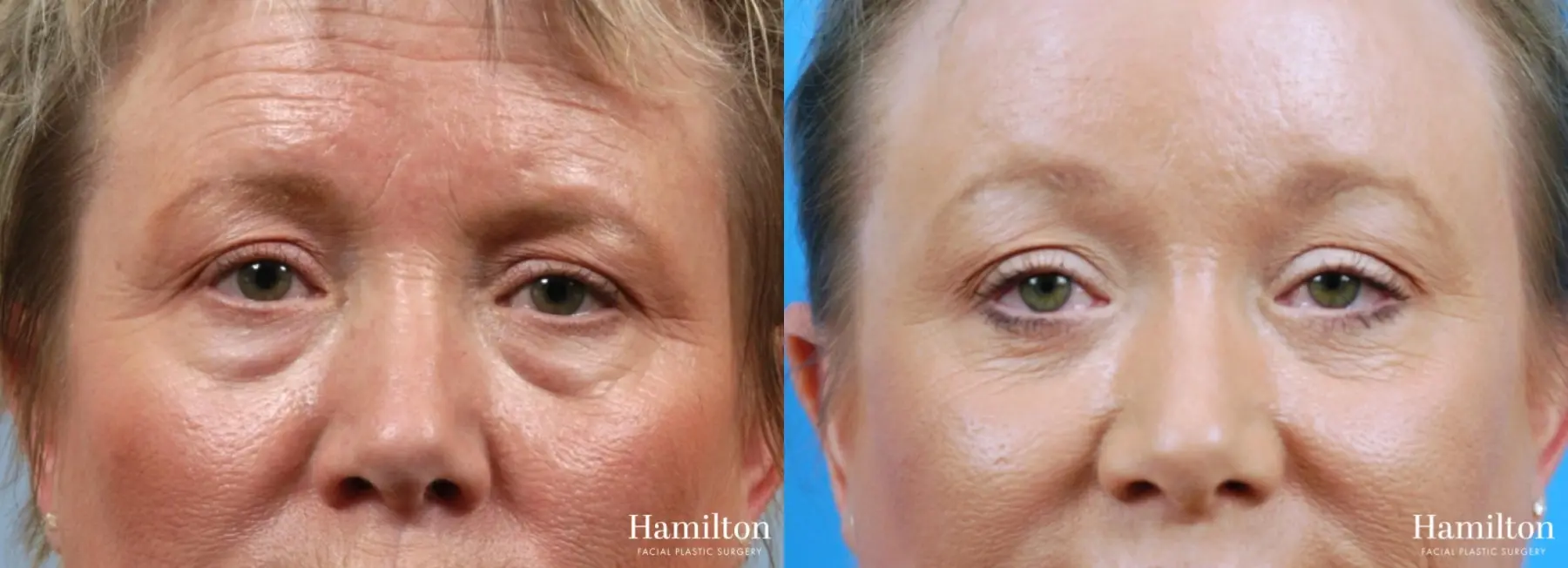 Blepharoplasty: Patient 11 - Before and After 1