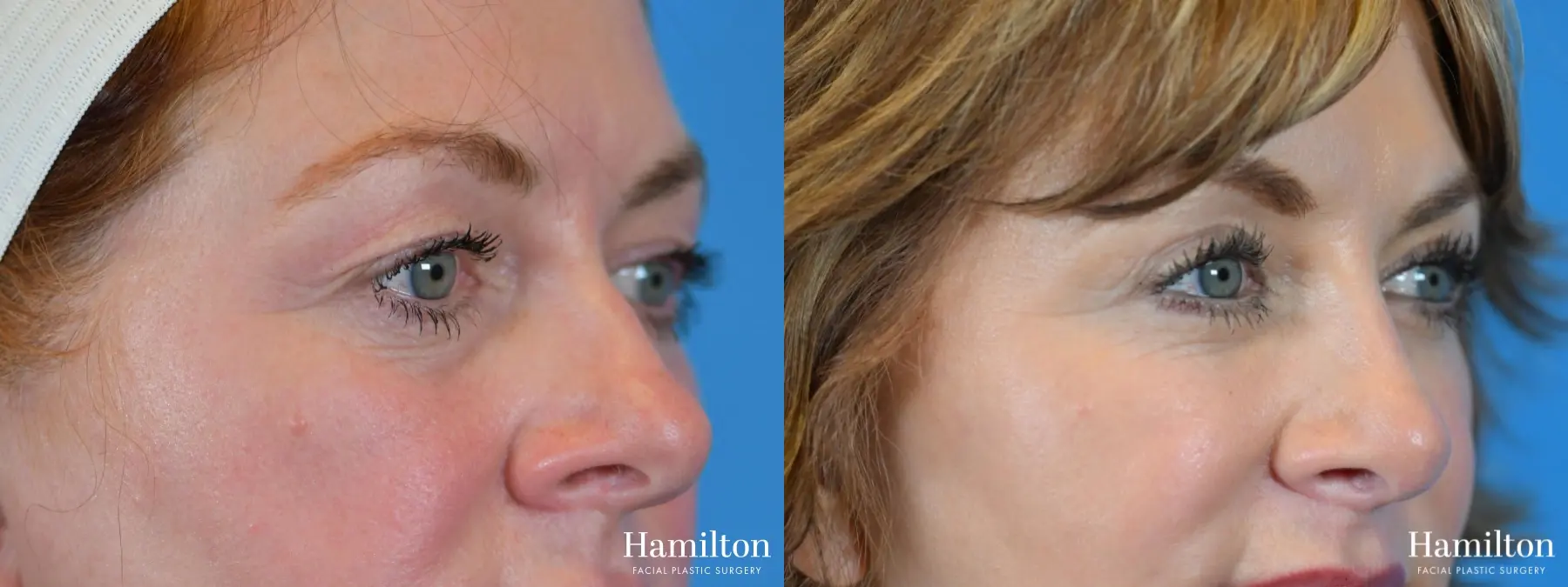 Blepharoplasty: Patient 9 - Before and After  