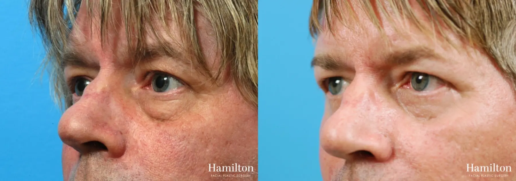 Blepharoplasty: Patient 23 - Before and After 3