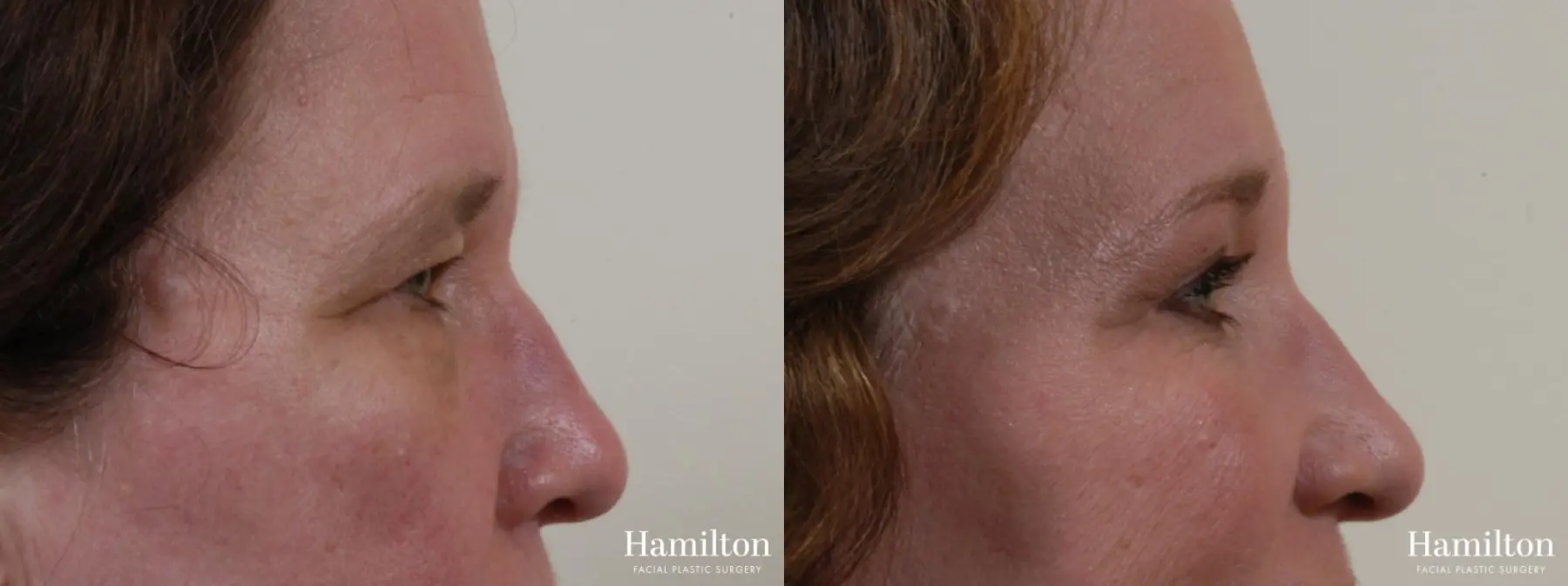 Blepharoplasty: Patient 7 - Before and After 5