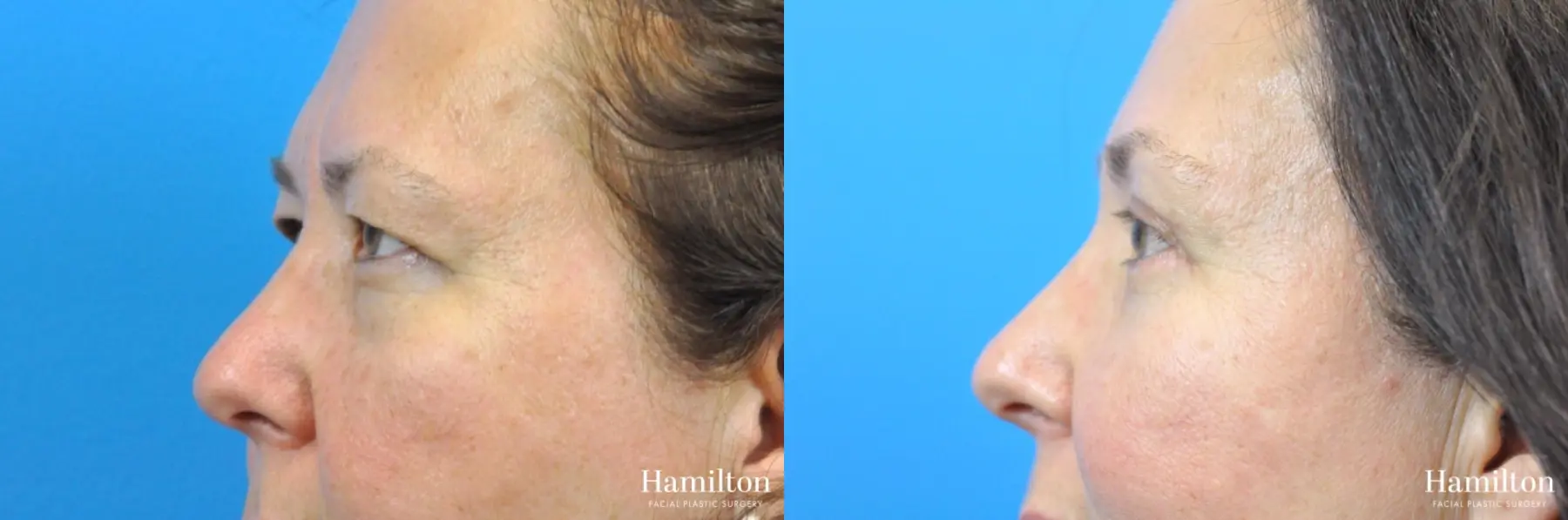 Blepharoplasty: Patient 21 - Before and After 5