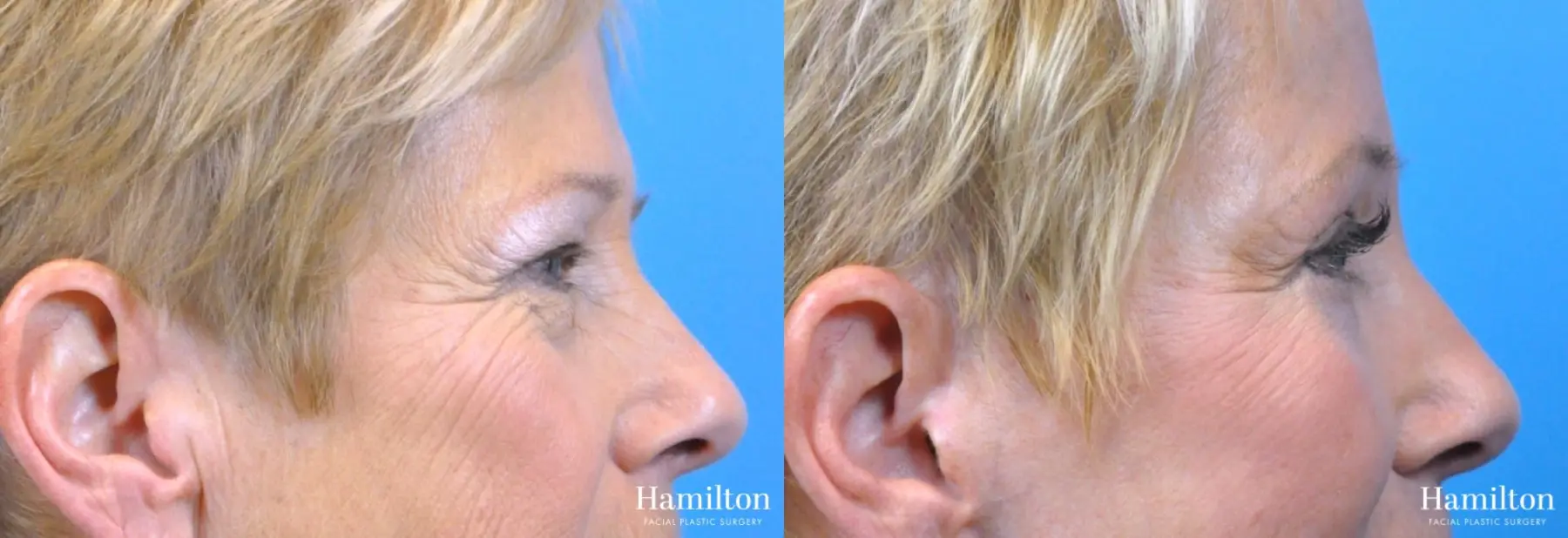 Blepharoplasty: Patient 4 - Before and After 4