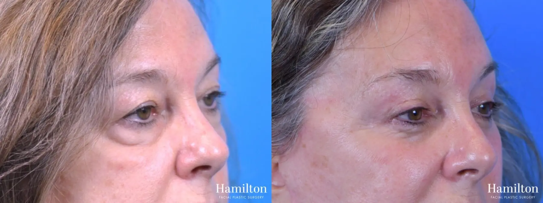 Blepharoplasty: Patient 14 - Before and After 3