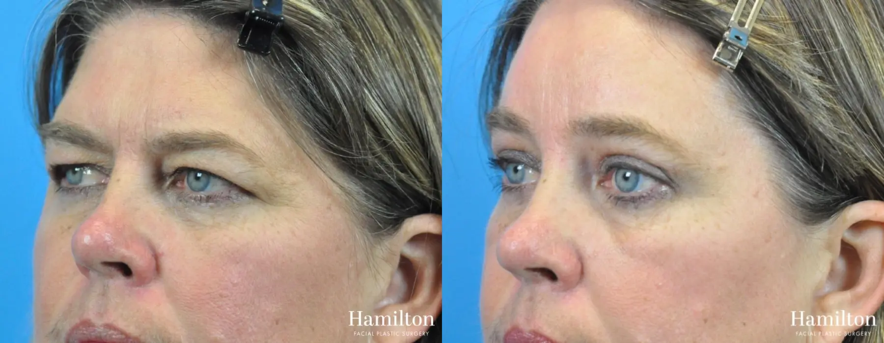 Blepharoplasty: Patient 16 - Before and After 3