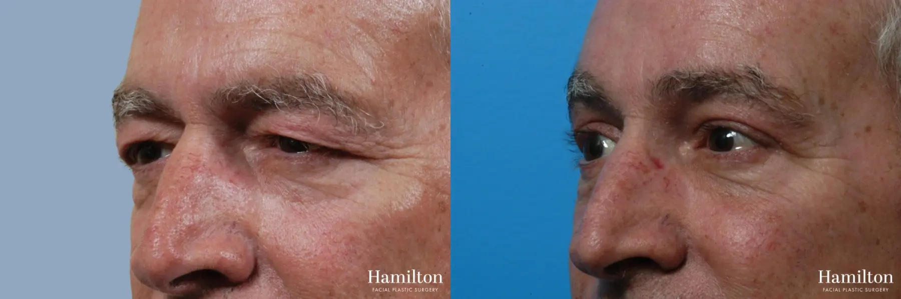 Blepharoplasty: Patient 24 - Before and After 2