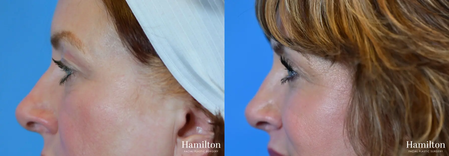 Blepharoplasty: Patient 9 - Before and After 2