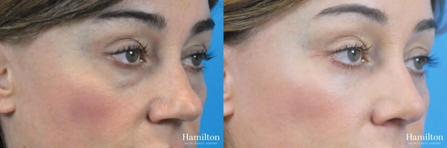 Blepharoplasty: Patient 25 - Before and After 2