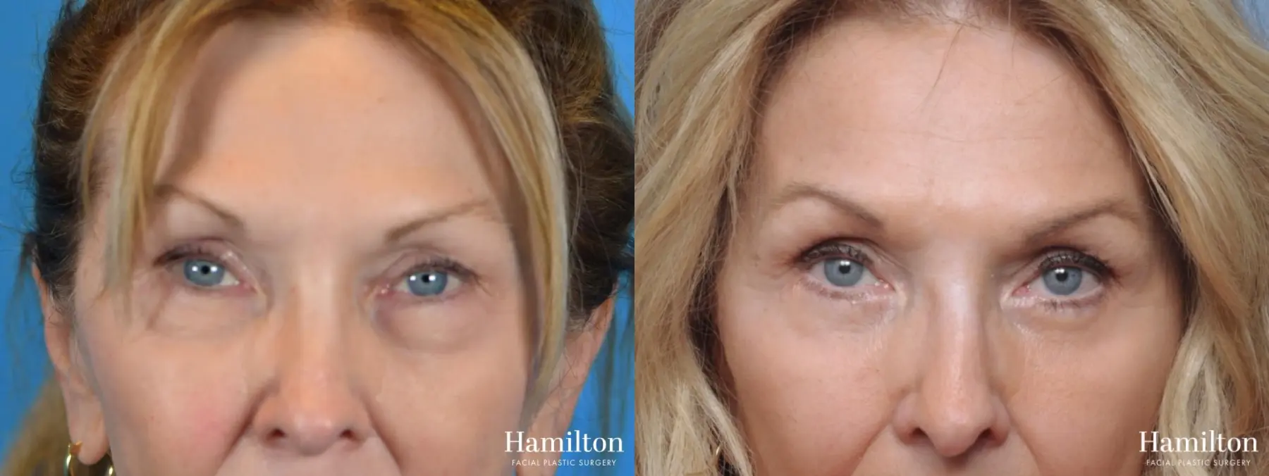 Blepharoplasty: Patient 1 - Before and After 2