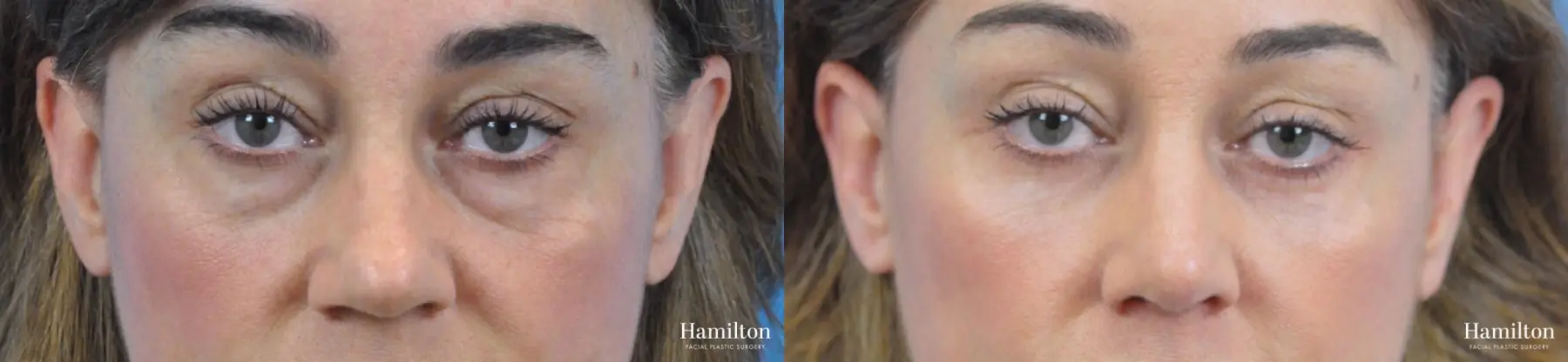 Blepharoplasty: Patient 25 - Before and After 1