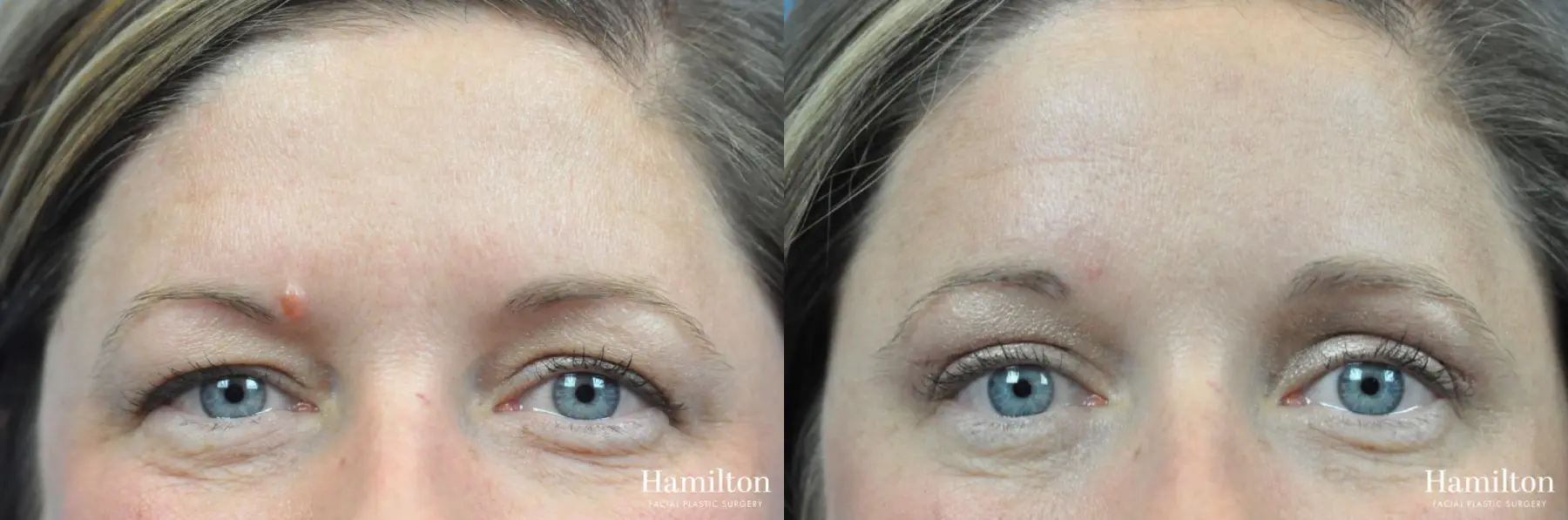 Blepharoplasty: Patient 17 - Before and After 1